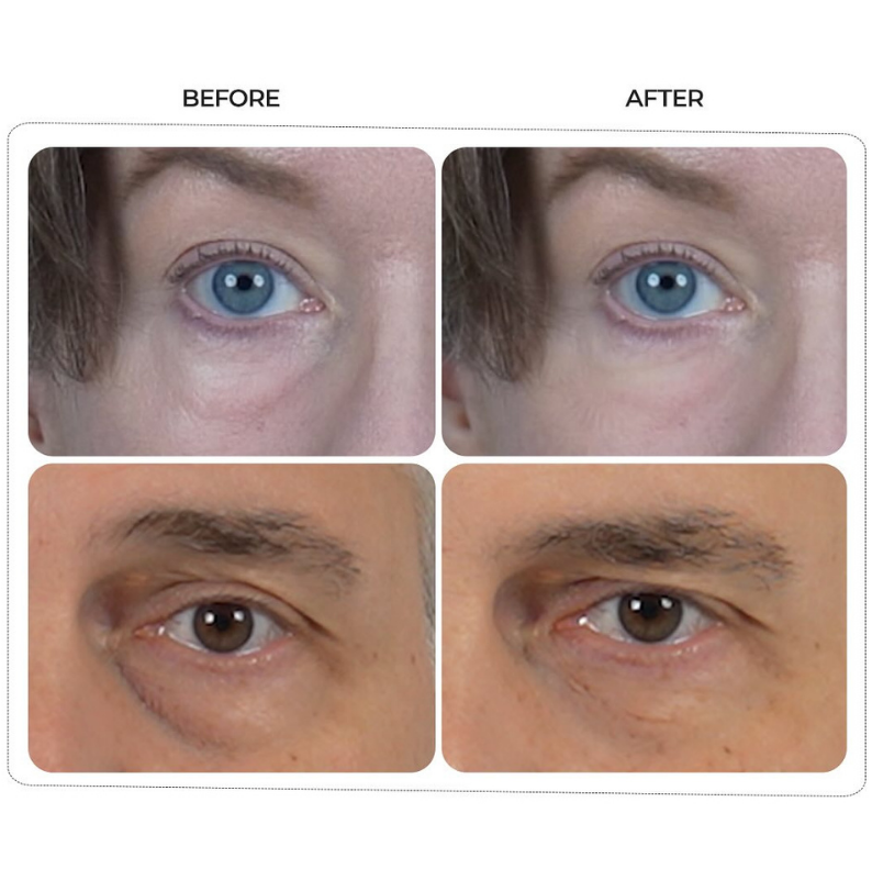 Eyephalt Eyebag Cream