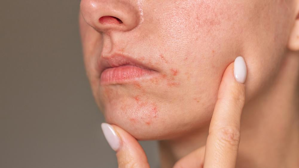 Perioral Dermatitis_blog
