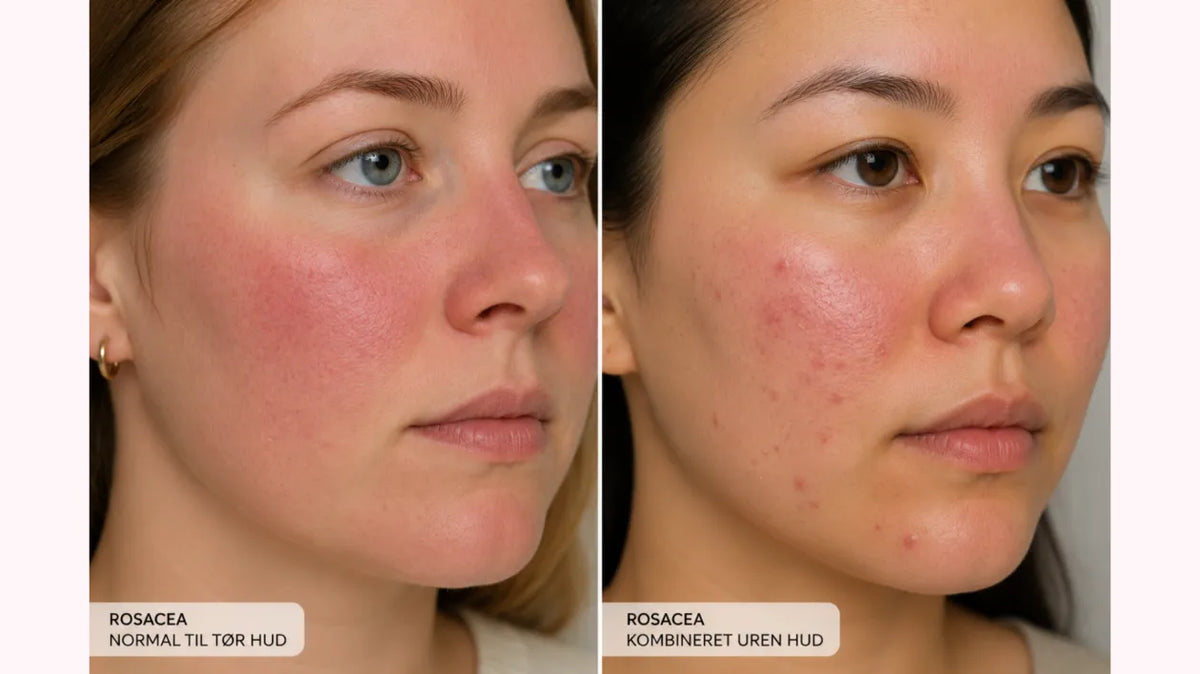 Rosacea – sådan plejer du en hud med tendens til rødme